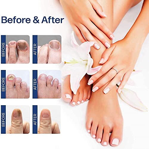 Fungal Nail Treatment,Nail Fungus Treatment For Toenail,Toe Nail Fungal Treatment,Ingrown Toenail Treatment,Toenail Fungus Treatment For Toenails