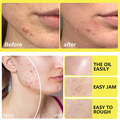 Hydrocolloid Acne Patch, Large Pimple Patch Spot Control Cover, Acne Patch for Covering Large Breakouts, Spot Patch, Pimple Stickers for Body, Ch