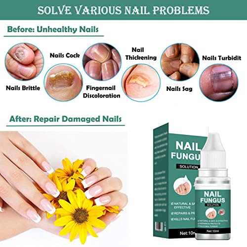 Fungal Nail Treatment for Toenail Extra Strong, Safety Effective Nail Fungus Solution, Ingrown Toenail Treatment Nail Care Oils, Anti Toe Toenail
