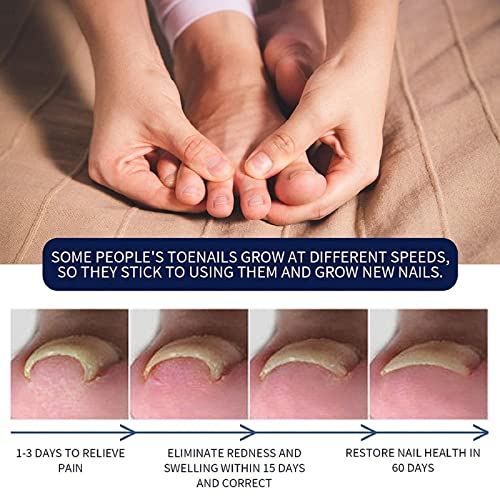 Ingrown Toenail Treatment,Nail Helper,Nail Growth Treatment,Ingrowing Toenail Treatment,Ingrown Toenail Correction Drops,Ingrown Toenail Correcto