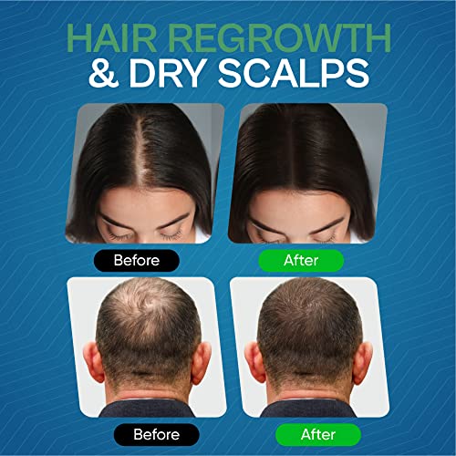 Rosemary Oil For Hair Growth Natural Serum, with Biotin, Sunflower Oil, Argan Oil and Rosemary Oil Natural Hair Growth Oil with Pre Diluted Rosem