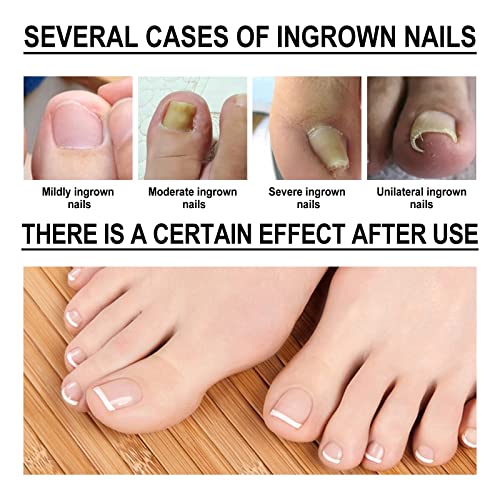 Ingrown Toenail Treatment,Nail Helper,Nail Growth Treatment,Ingrowing Toenail Treatment,Ingrown Toenail Correction Drops,Ingrown Toenail Correcto