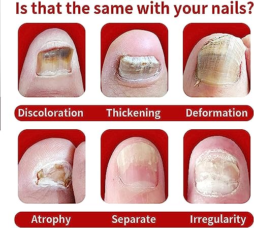 Nail Onychomycosis Rapid Relief Oil,Onychomycosis Rapid Relief Oil,Onychomycosis Nail Treatment Oil,Toenail Repair for Damaged Nails,Collagen Boo