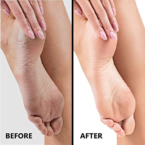 SlkySmooth 3-in-1 Foot File | Hard Dead Skin Remover | Cracked Heels Callus Pedicure Scrubber Corn Removal | Scraper Grater Pumice Stone Exfoliat