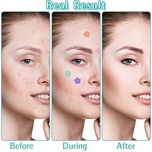 Fuyamp 60 Pcs Pimple Patches Star Spot Patches, Acne Spot Patch Acne Stickers for Skin Treatment, Moisturizing, Blemish Spot, Ideal Fast Healing