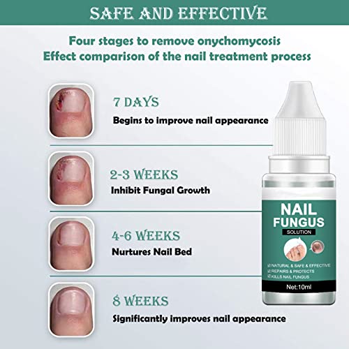 Fungal Nail Treatment for Toenail Extra Strong, Safety Effective Nail Fungus Solution, Ingrown Toenail Treatment Nail Care Oils, Anti Toe Toenail