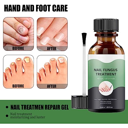 Fungal Nail Treatment, Nail Repair Kit For Broken Natural Nails, Extra Strong Fungal Nail Treatment For Toenails And Fingernail, Ingrown Toenail