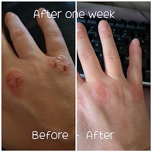 Natural Propolis Cream Manuka Honey Cream Moisturiser Also Suitable (or Safe) For People Who May Be Prone to Problem Dry Skin Cream Cracked Dry H