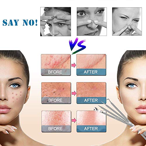 Blackhead Remover Kit, Extractor Removal Set Professional Stainless Steel Pimple Popper Tool Treatment for Whitehead Blemish Acne Comedone Pimple