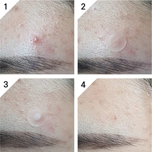 DDOWA Hydrocolloid Acne Pimple Patch - 99 Patches, Size 10mm & 12mm - Fast-Acting & Cleansing Zit, Blemish & Spot Treatment - Covers & Cleans Por