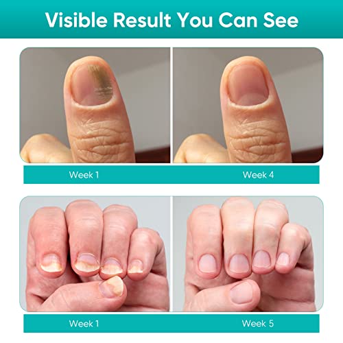 Chinoxia Fungal Nail Treatment, Extra Strong Nail Fungus Treatment for Toenail, Nail Repair Kit with File and Brush -30ml