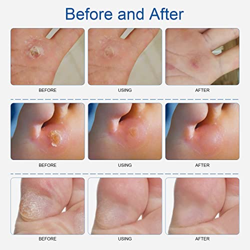 Corn Remover Pads, Wart Remover, Foot Corn Remover Patch, 24 Pcs Corn Removal Pads,Corn Plaster with Hole for Feet, Hand, Toe for Feet Care and C