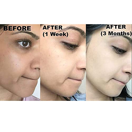 Kojie San Skin Lightening Kojic Acid Soap 3 Bars - 100g Fades Age Spots, Freckles, and Other Signs of Sun Damage and Heals Acne Blemishes and Era