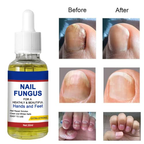 Nail Fungal Treatment, Toenail Treatment Extra Strong Nail Repair Set, Fingernail Toenail Care, Fix Renew Damaged, Broken, Anti Fungus Nail Repai