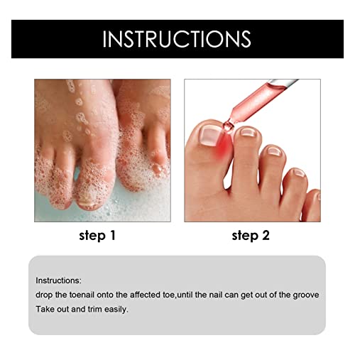 Ingrowth Toenail Correction Treatment Oil, Ingrown Toenail Treatment Kit, Correction Ingrown Toenail Drops, Cuticle Nail Oil Nail Fungal Treatmen