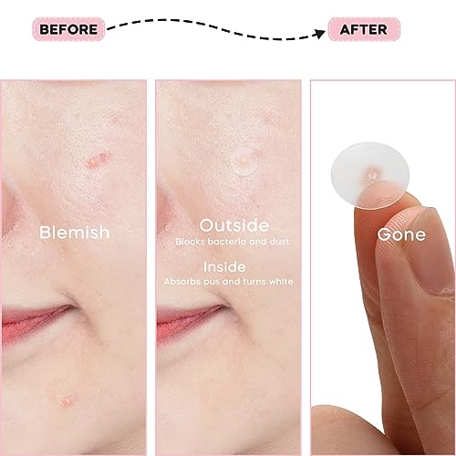 Spot Patches, Acne Patch 112 Pcs, Hydrocolloid Pimple Patches, Korintin Acne Patches for Large Zit Breakouts, 3 Sizes (8mm, 10mm, 38mm x 26mm)