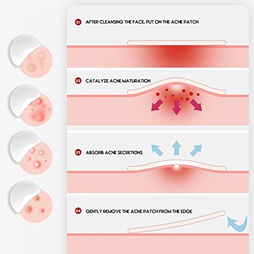 LacyMC 60 Patches Acne Patches,Size 8mm & 12mm,Hydrocolloid Dressing Cover,Dots for Spots Pimple Patches