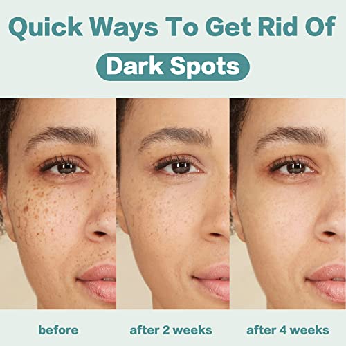 Dark Spot Remover for Face and body, Dark Spot Corrector Cream-for Dark Spots, Sun Spots, Age Spots, Hyperpigmentation and Even Skin Tone-1.7 Oz
