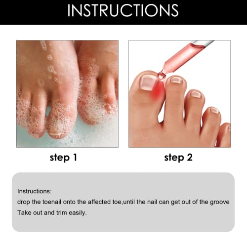 Ingrown Toenail Treatment Drop- Ingrown Toenail Treatment- Cuticle Care Oils for Ingrown Toenails - Trimming Toenail Softening Drops Natural Ingr