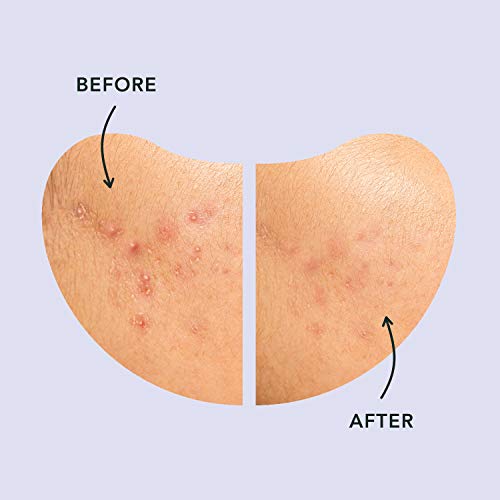 Rael Pimple Patches, Miracle Large Spot Control Cover - Spot Patches, Long Size, Hydrocolloid Strip for Breakouts Extra Coverage Acne Patch, All