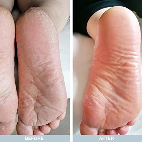 Foot Cream from Australian Bodycare 100ml | Hard Skin Remover for Women & Men | Treatment against Hard, very Dry & Cracked Feet with 10% Urea | F