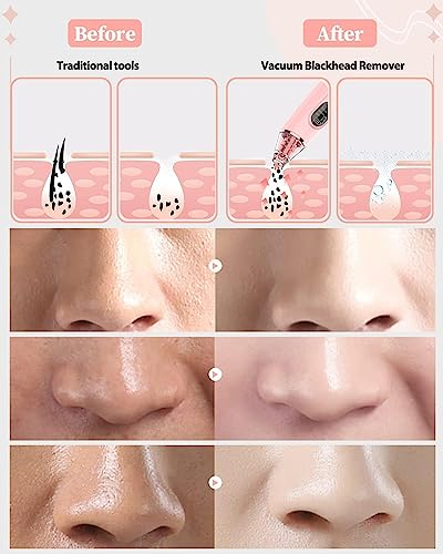 Blackhead Remover Vacuum Electric Blackhead Remover Pore Vacuum Pore Cleaner with 3 Levels and 4 Suction Heads - Face Pore Vacuum Blackhead Remov