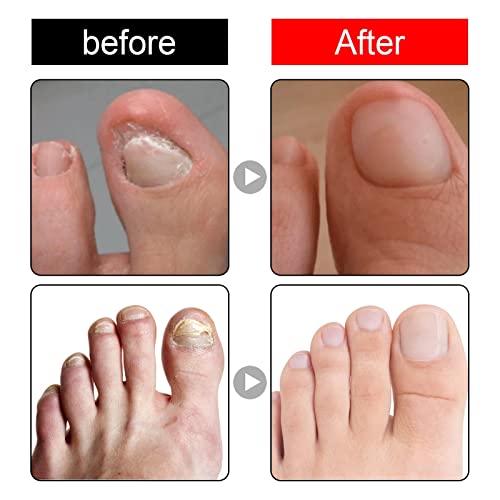 Ingrown Toenail Treatment,Nail Helper,Nail Growth Treatment,Ingrowing Toenail Treatment,Ingrown Toenail Corrector,Treatment For Ingrown Toenail,I