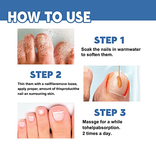 Nail Fungus Treatment Cream, 30g Strong Anti-Fungus Nail Treatment for Toenail Fungus, Fungal Nail Treatment For Athlete's Foot and Nail Infectio