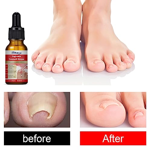Ingrown Toenail Treatment,Fungal Nail Treatment,Ingrown Toenail Drops,Nail Care and Treatment,Strengthen Renew Damaged Nail(30ML)