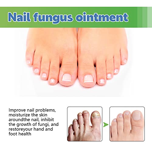 Nail Fungus Treatment Cream, 30g Strong Anti-Fungus Nail Treatment for Toenail Fungus, Fungal Nail Treatment For Athlete's Foot and Nail Infectio