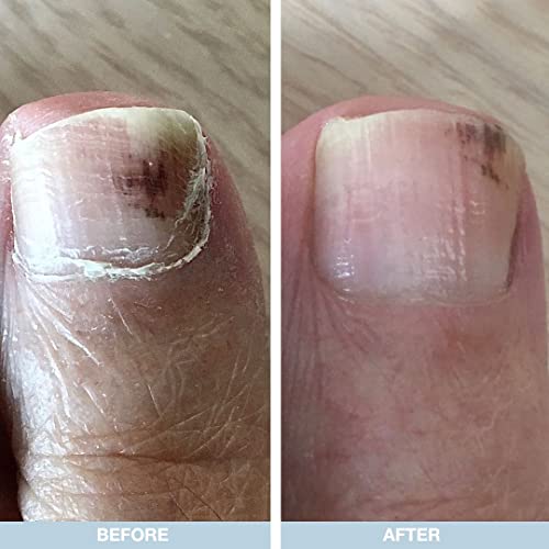 Australian Bodycare Nail Repair | Nail Care for Women & Men with Damaged & Discolored Nails | with Application Brush | Also for Supporting Care f