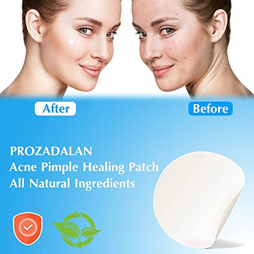 Spot Patches, 216pcs Invisible Hydrocolloid Pimple Patches, Effectively Relieve Common Spot Patches for Face, Facial Care, Suitable for All Skin
