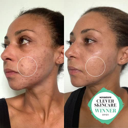 Clinisoothe+ Skin Purifier 250ml - Spot and Acne Treatment For Face and Body, Prevent Breakouts And Promote Rapid Recovery With Hypochlorous Tech