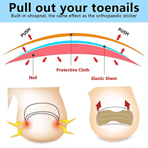 Ingrown Toenail Correction Patch Ingrown Toenail Sticker Patch 50PCS Nail Correction Sticker with 4PCS Nail Correction Tool,Glue-Free Toenail Cor