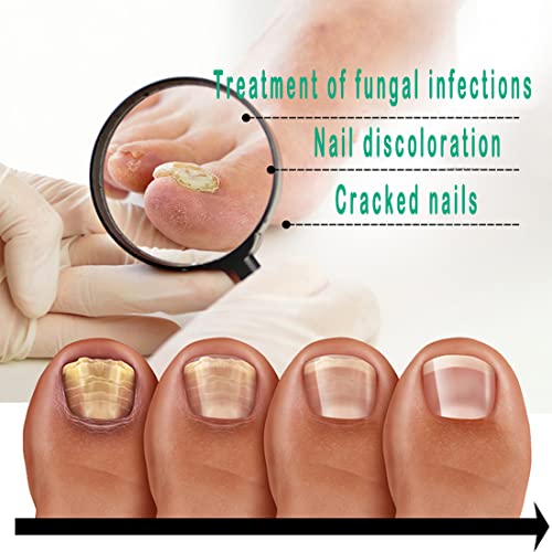Kerassentials Toenail Fungus Treatment Oil, Best Repair Solution for Fingernails and Toenails, Fix & Renew Damage Fungal Nail, Broken, Cracked &