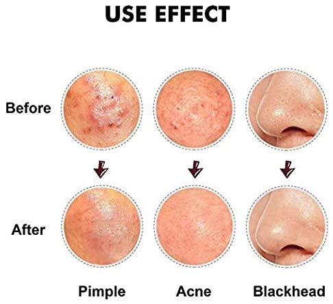 Blackhead Remover Tool Kit Comedone Extractor, Karpo 5 in1 Blackhead Cleaner Tweezers Kit, Curved Professional Stainless Pimple Acne Blemish Remo