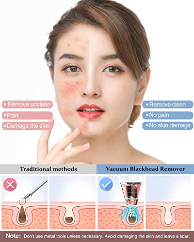 Blackhead Remover Vacuum, Electric Blackhead Remover Vacuum Pore Vacuum with 3 Levels and 4 Suction Heads - Blackhead Suction Remover Blackhead R