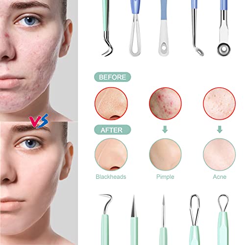 Blackhead Remover Pimple Popper Tool Kit 10 Pcs, Comedone Pimple Extractor Tool, Acne Kit for Blackhead, Whitehead Popping, Zit Removing (Blue)