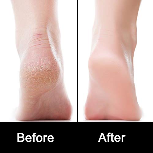 FOLAI Foot Files, Foot File Foot Pedicure Kit, Stainless Steel Foot Files,Stainless Steel File, Foot File Foot Care Pedicure Tool for Both Wet an