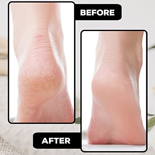 Foot Files for Hard Skin Pedicure Metal Surface Foot Scraper Dead Skin Remover for Feet Callus Rasp