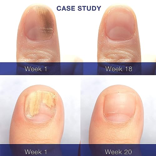Dr. Luke Finger Nail and Toe Nail Fungus Treatment Extra Strength, Fungal Nail Renewal, Fungus Nail Treatment, Fungi Nail Repair for Nail antifun