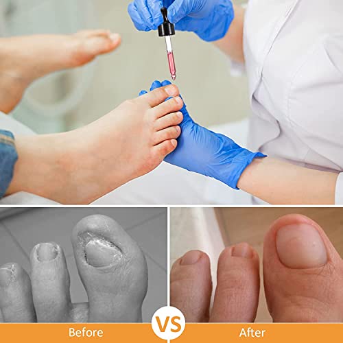 Ingrown Toenail Treatment,Nail Helper,Nail Growth Treatment,Ingrowing Toenail Treatment,Ingrown Toenail Corrector,Treatment For Ingrown Toenail,I