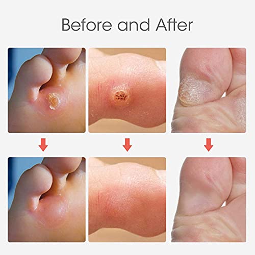 Corn Remover Pads, Wart Remover, Foot Corn Remover Patch, 24 Pcs Corn Removal Pads,Corn Plaster with Hole for Feet, Hand, Toe for Feet Care and C
