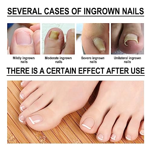 Ingrown Toenail Treatment,Fungal Nail Treatment,Ingrown Toenail Drops,Nail Care and Treatment,Strengthen Renew Damaged Nail(30ML)