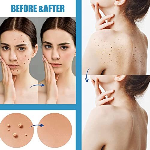 CBROSEY Skin Tag Removal Patches,Mole Remover,Acne Pimple Master Patch