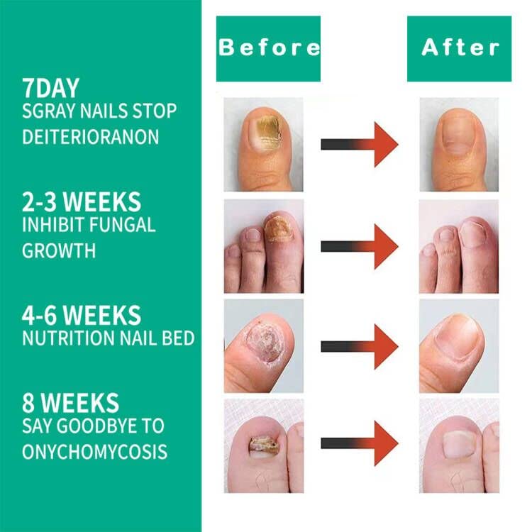 Kerassentials Toenail Fungus Treatment Oil, Best Repair Solution for Fingernails and Toenails, Fix & Renew Damage Fungal Nail, Broken, Cracked &