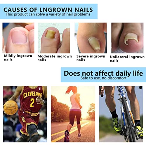 Ingrown Toenail Correction Patch Ingrown Toenail Sticker Patch 50PCS Nail Correction Sticker with 4PCS Nail Correction Tool,Glue-Free Toenail Cor