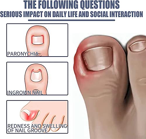 Ingrown Toenail Treatment,Nail Helper,Nail Growth Treatment,Ingrowing Toenail Treatment,Ingrown Toenail Corrector,Treatment For Ingrown Toenail,I