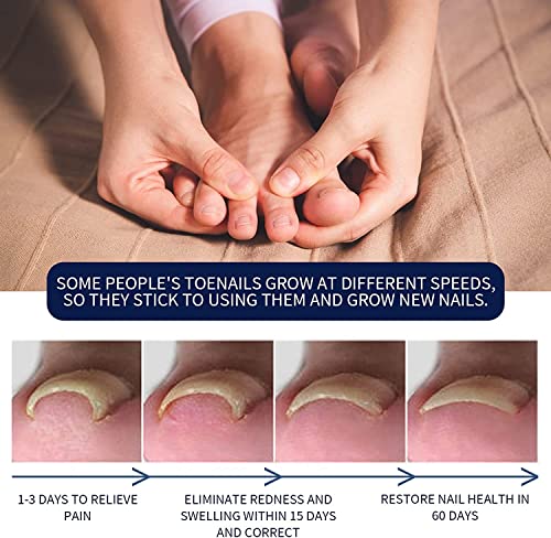 Ingrown Toenail Treatment,Nail Helper,Nail Growth Treatment,Ingrowing Toenail Treatment,Ingrown Toenail Corrector,Treatment For Ingrown Toenail,I