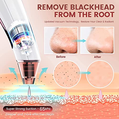 Blackhead Remover Vacuum, Electric Blackhead Remover Vacuum Pore Vacuum with 3 Levels and 4 Suction Heads - Blackhead Suction Remover Blackhead R